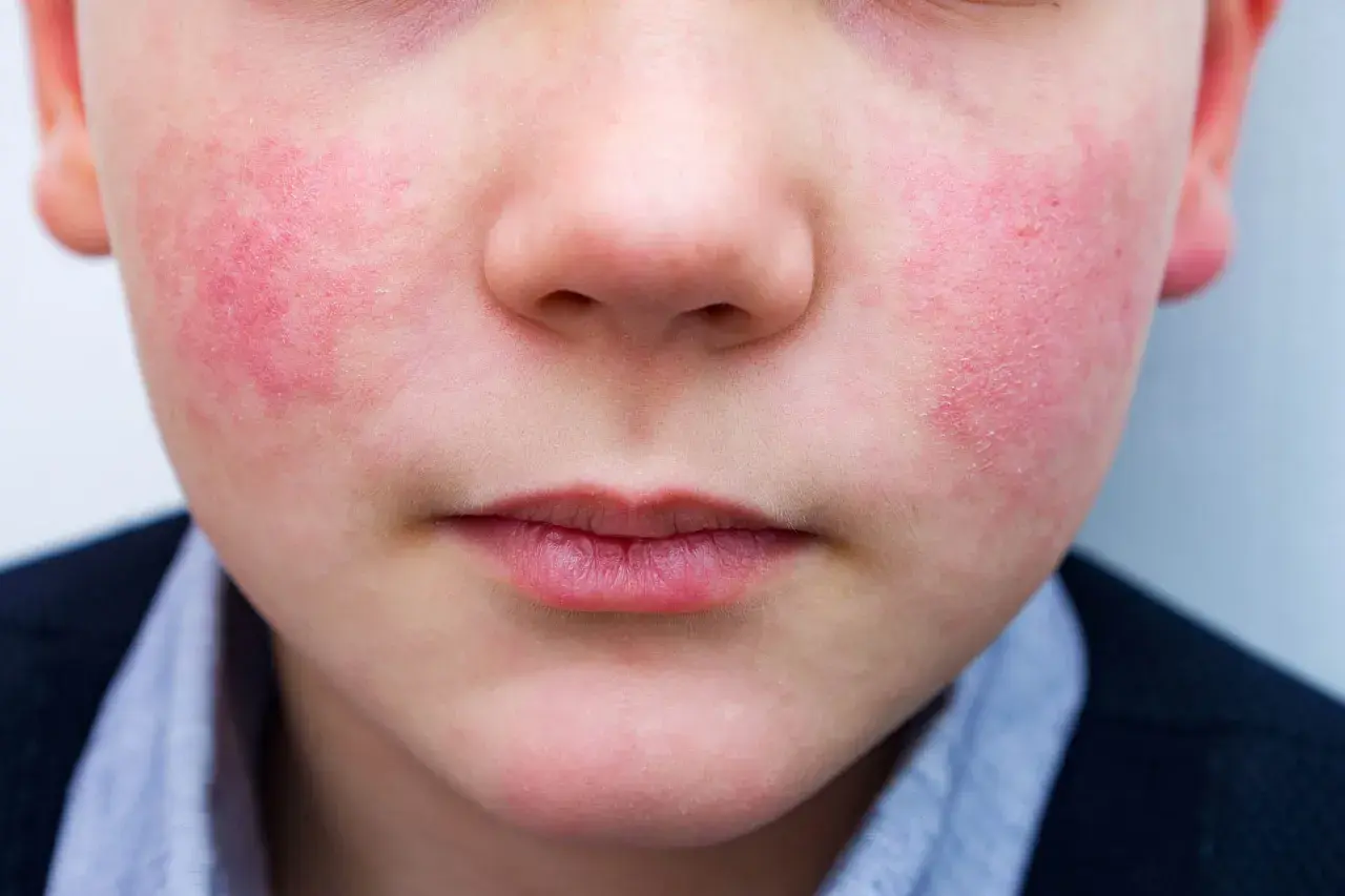 Primo piano del viso di un bambino con guance rosse e calde, forse per il freddo o un'allergia.