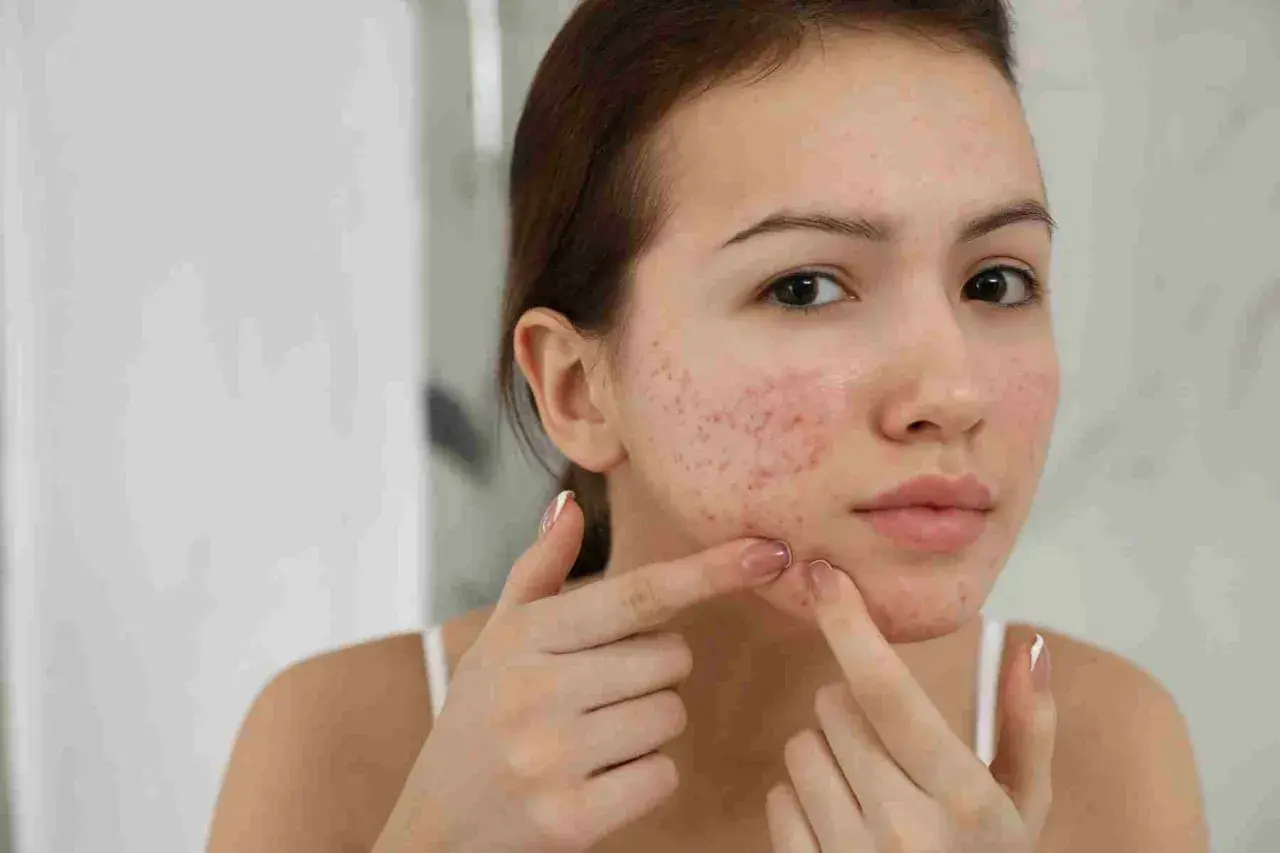 Ragazza con acne in gravidanza, si tocca il viso con le dita.