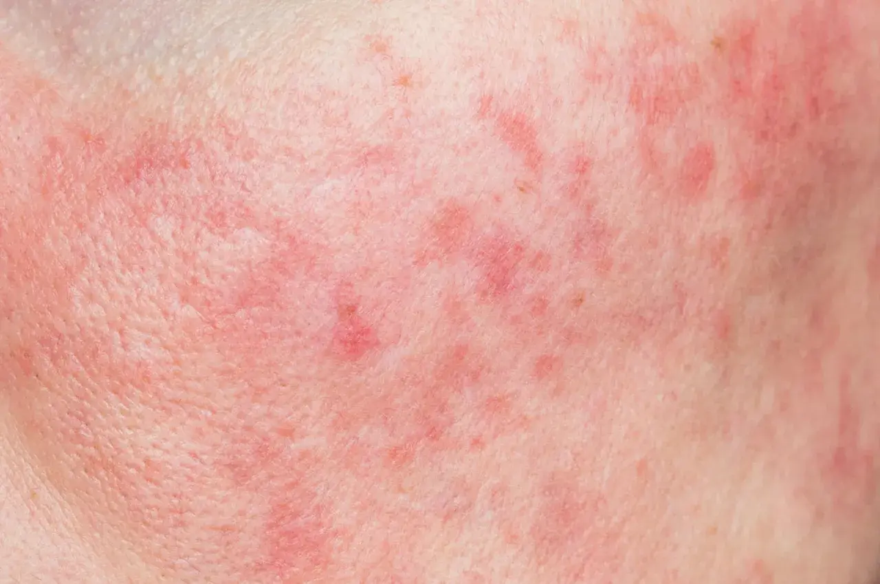 Pelle arrossata con piccole macchie rosse e pori dilatati, segno di ipersensibilità cutanea.