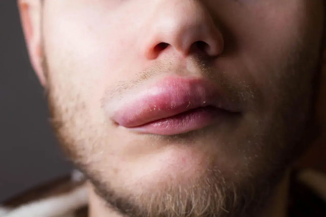 Labbro superiore gonfio improvviso, sintomo di angioedema. La pelle appare tesa e arrossata.