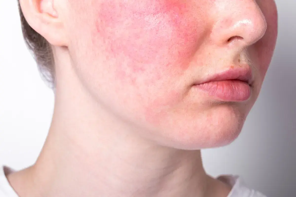 Guance arrossate e visibili sfoghi sul viso da stress, con labbra leggermente secche.