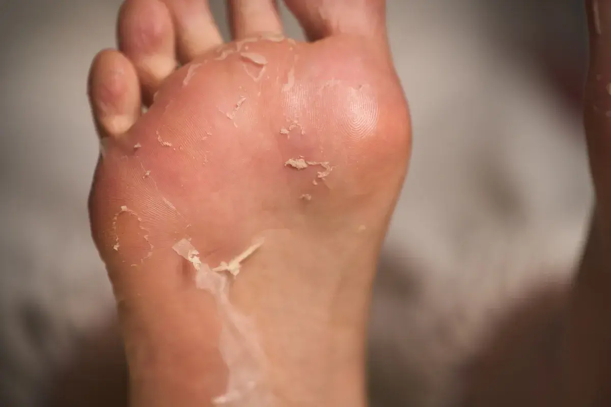 Primo piano di piedi che si spellano, con la pelle secca che si stacca dalla pianta e dalle dita.