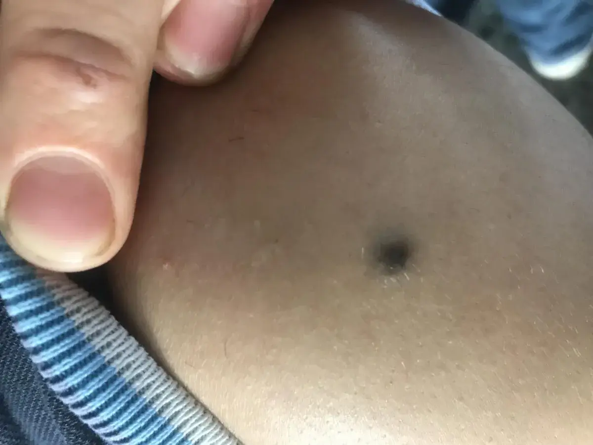 Dito, un dito indica un **punto nero gigante** sulla pelle.