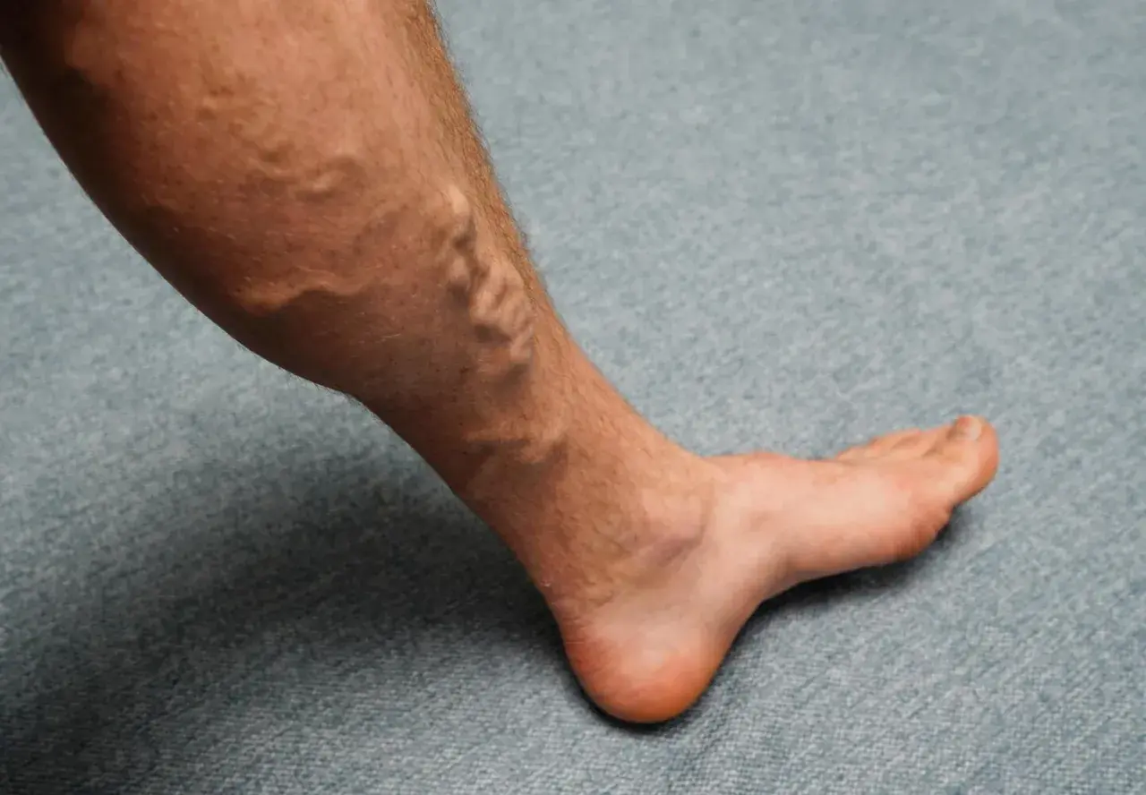 Gamba con vene varicose evidenti, un segnale che potrebbe richiedere rimedi per gambe gonfie.