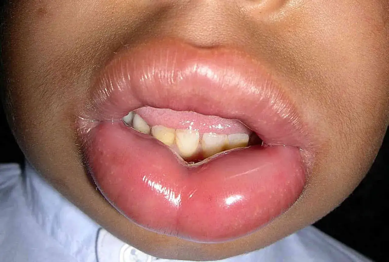 Labbro superiore gonfio e lucido, segno di angioedema improvviso. Si intravedono denti e lingua.