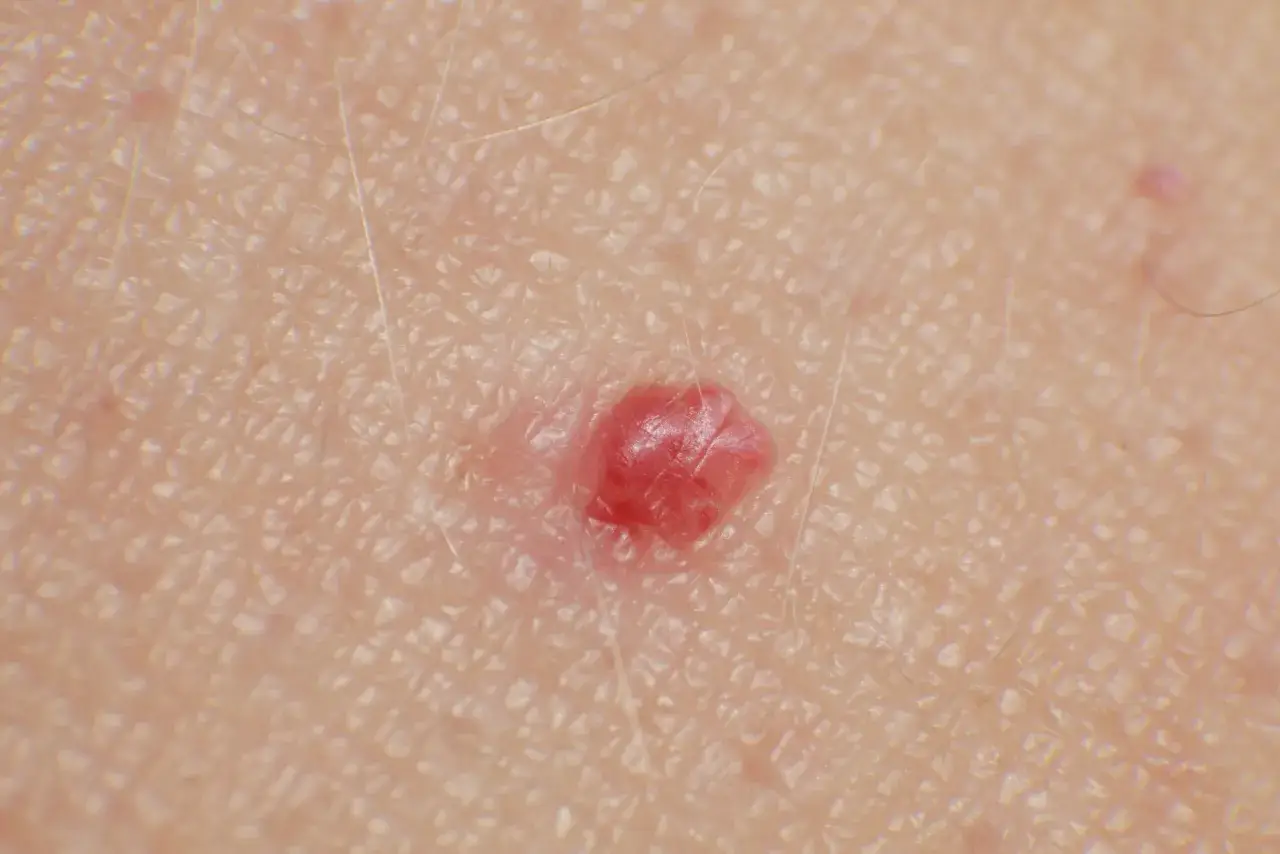 Primo piano della pelle con un neo rosso, un piccolo rilievo sulla superficie cutanea, circondato da sottili peli chiari.