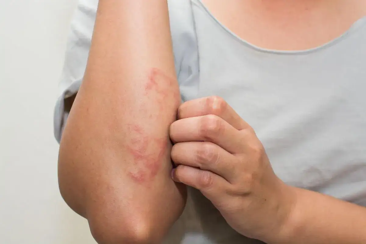 Un braccio con eruzione cutanea rossa e circolare, che causa un forte prurito sulle braccia. La mano si gratta la zona interessata.