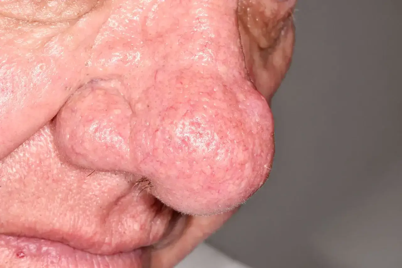 Primo piano di un naso rosso con capillari visibili e una piccola protuberanza. La pelle appare ruvida e arrossata.