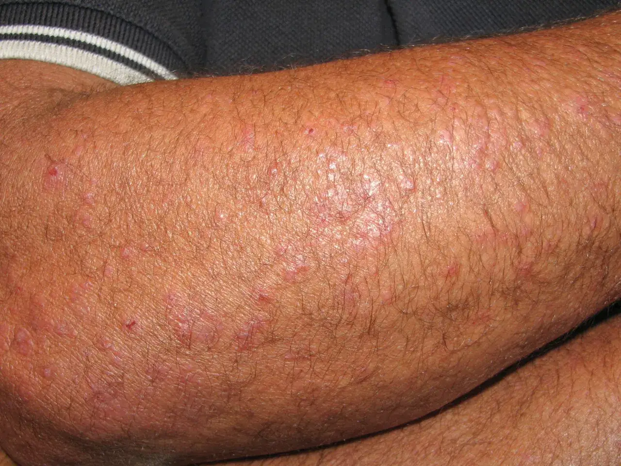 Pelle arrossata e irritata con piccoli brufoli, sintomo di prurito alle braccia in estate.