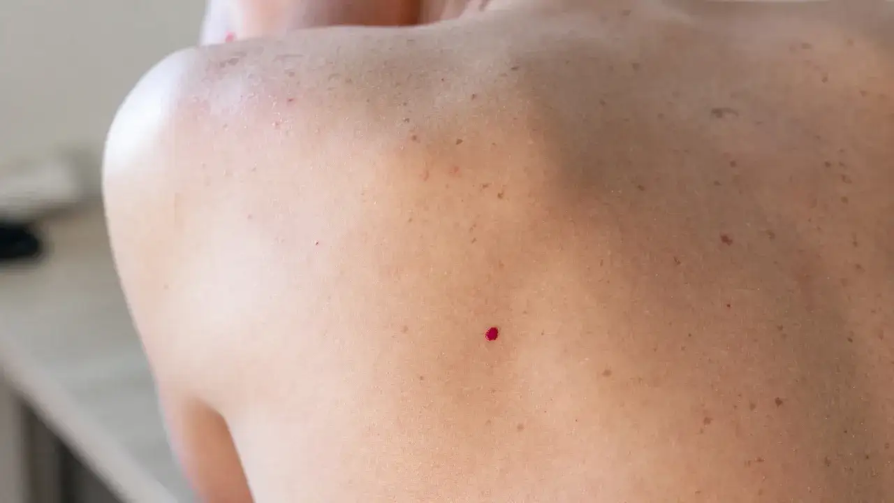 Primo piano della schiena con un angioma rubino e piccole macchie. Si cercano rimedi naturali.