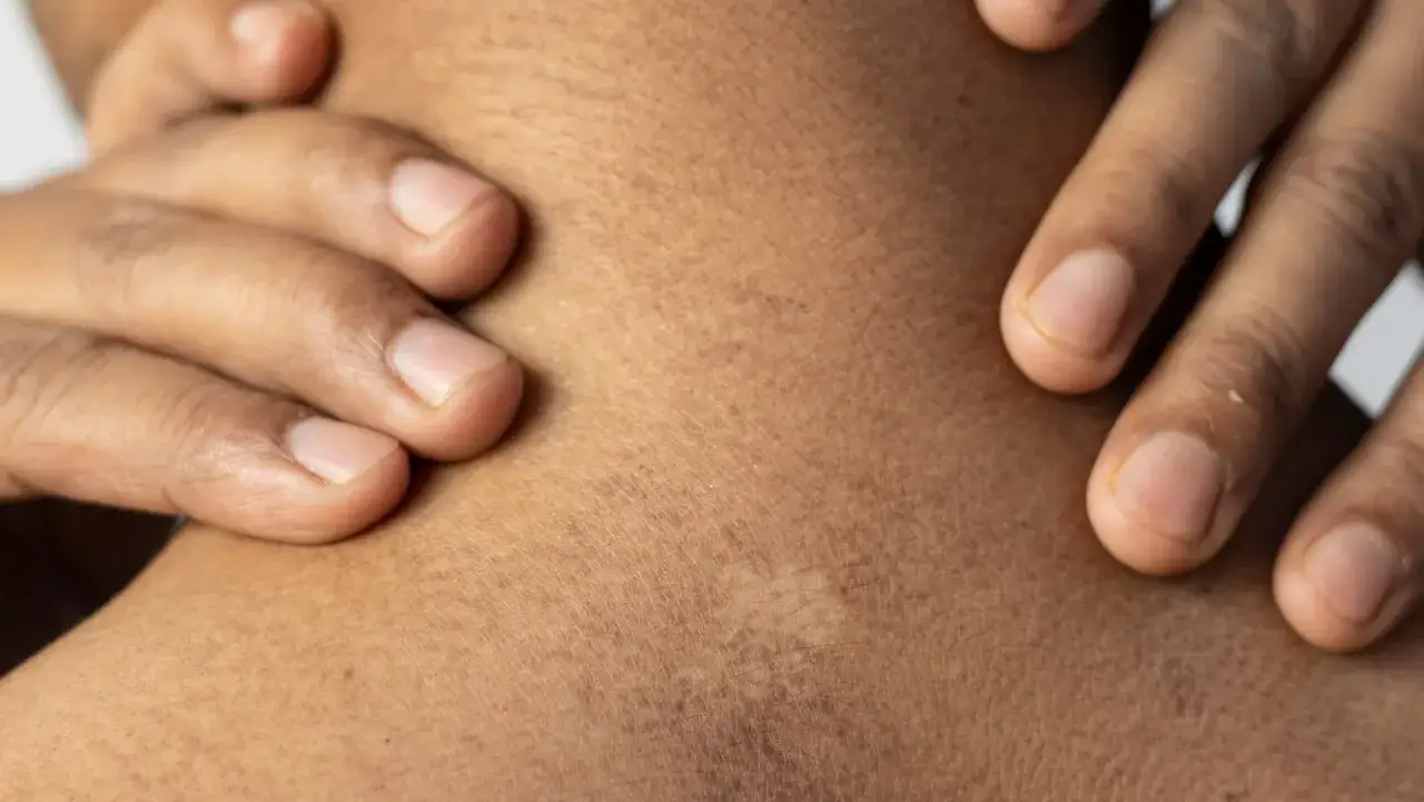 Dita che toccano la pelle del collo, evidenziando macchie bianche che potrebbero indicare anemia.