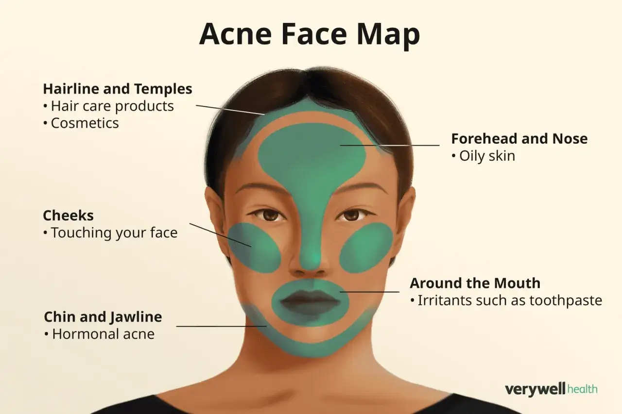 Mappa dell'acne: la fronte e il naso sono aree con pelle grassa, spesso causa di brufoli.