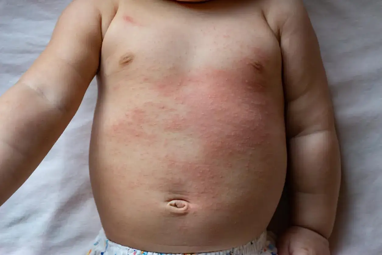 Corpo di neonato con eruzione cutanea rossa e piccole bolle da sudore sul petto e sull'addome.