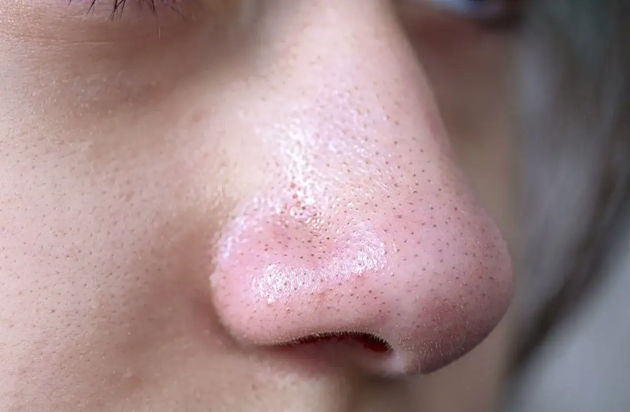 Primo piano del naso con pori dilatati e un punto nero infiammato. La pelle appare lucida e leggermente arrossata.