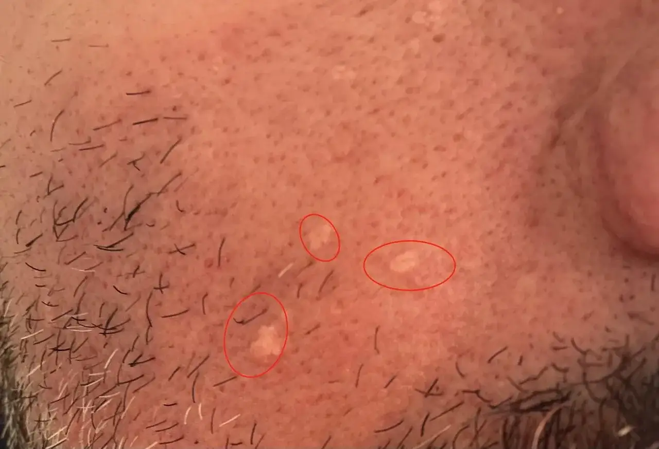 Pelle ruvida con puntini bianchi, forse residui di acne o piccole cicatrici.