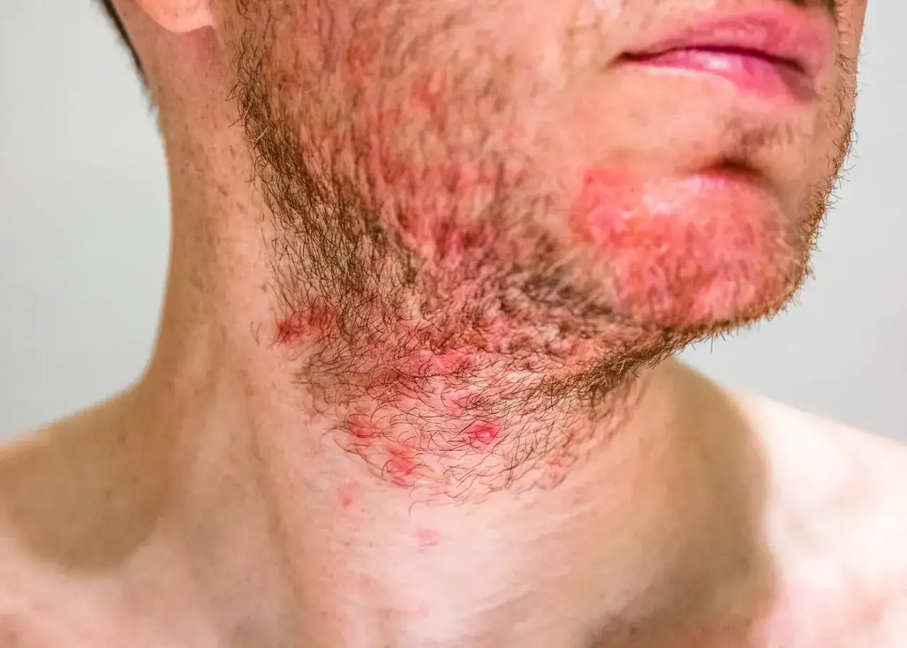 Irritazione e rossore sul viso e collo, con pustole evidenti, possibili sfoghi sul viso da stress.