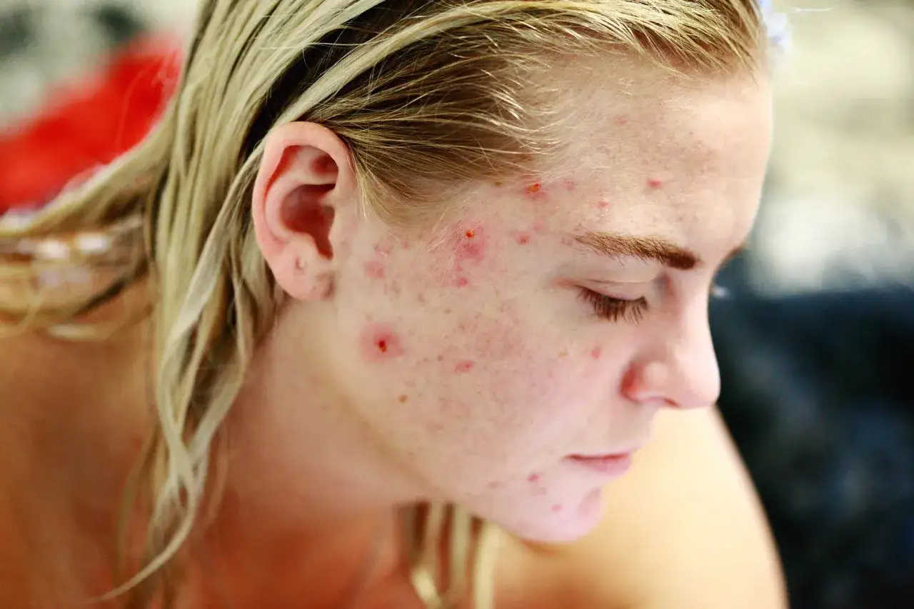 Close-up of a young woman's face with blonde hair, showing acne on her cheek and forehead.