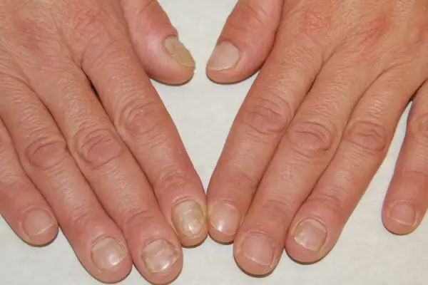 Mani con unghie che mostrano ispessimento e alterazioni del colore, con evidenti pellicine intorno alle unghie.