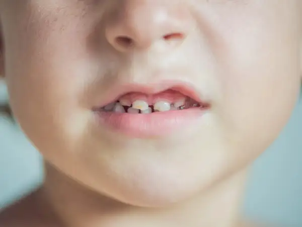 Primo piano del viso di un bambino con macchie bianche sulla pelle e denti da latte visibili.