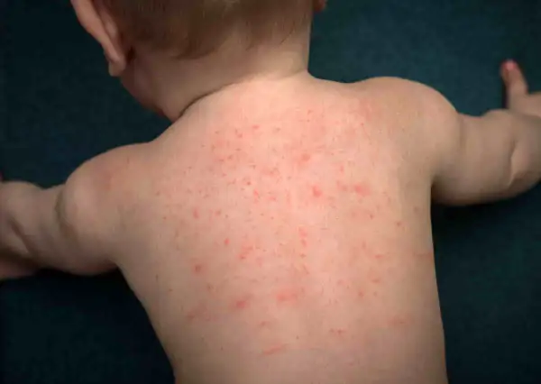 Schiena di un neonato coperta da piccole bolle da sudore rosse.