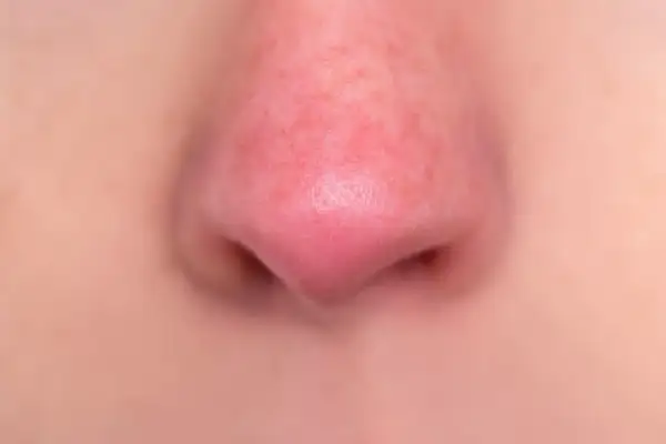Primo piano di un naso rosso, con la pelle leggermente arrossata e pori visibili.