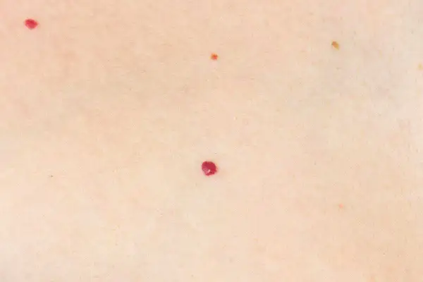 Pelle chiara con piccole macchie rosse, come rubini apparsi nei rossi all'improvviso, e una più scura.
