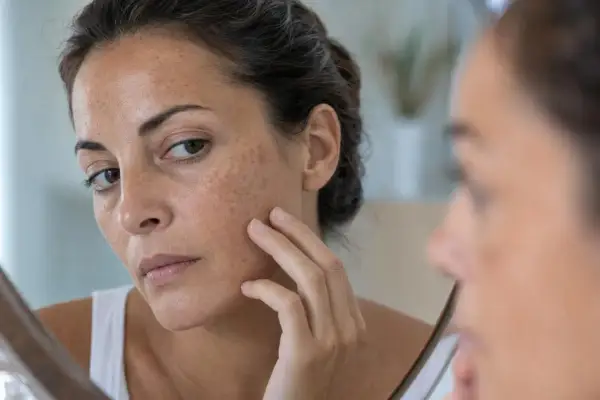 Donna si guarda allo specchio, toccandosi il viso dove si notano molte lentiggini. Cosa sono le lentiggini? Piccoli accumuli di melanina.