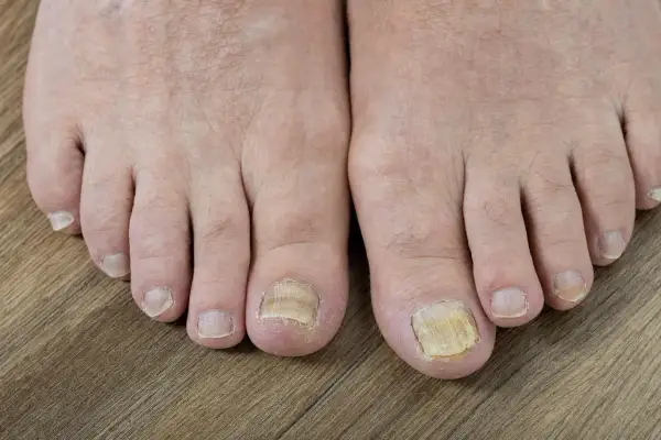 Piedi con unghie ispessite e ingiallite, possibili segni di micosi. La pelle morta sui piedi può avere varie cause.