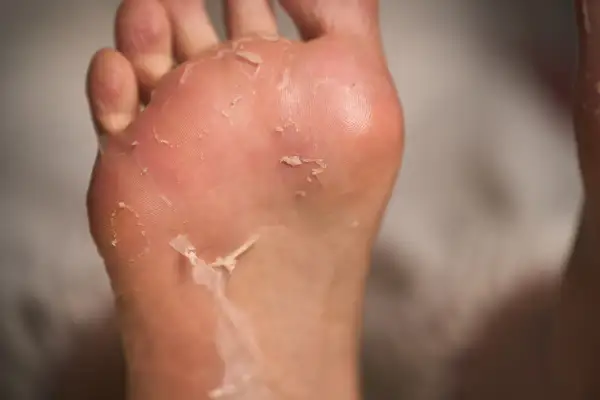 Primo piano di piedi che si spellano, con la pelle secca che si stacca dalla pianta e dalle dita.