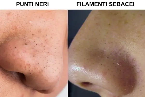 Primo piano del naso con punti neri e filamenti sebacei, un problema comune che si riforma sempre.